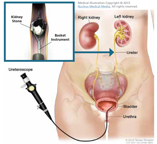 Ureteroscopy