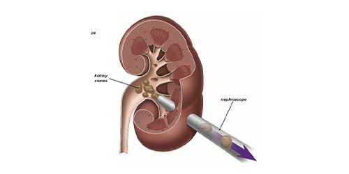 new-1 kidney