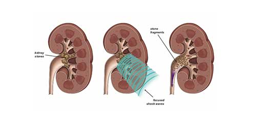 new-3 kidney